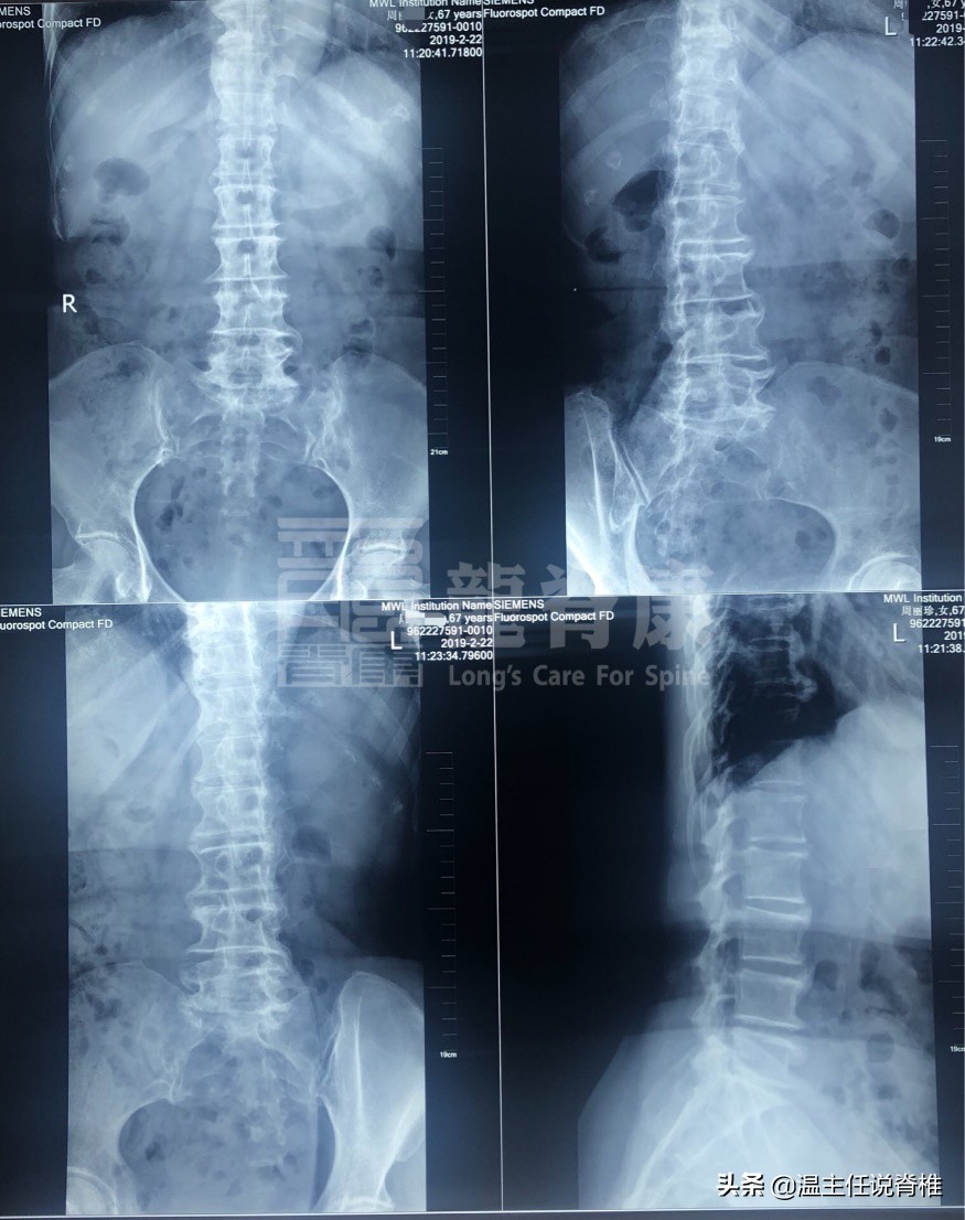 治多种腰痛的方法,腰痛转移到膝盖痛怎么治疗