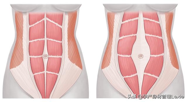 产后腹直肌分离恢复训练一个动作,产后腹直肌分离恢复训练视频