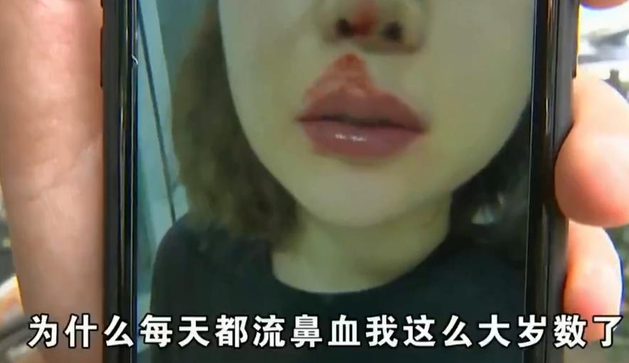 一弯腰就流鼻血？女子吃辣椒打喷嚏爆出“硬物”：我整个人都吓傻了
