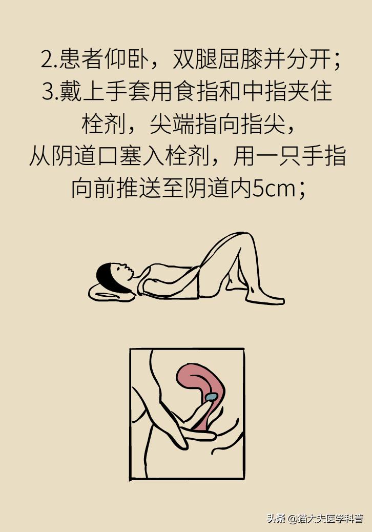 霉菌性阴道炎真的是里面“发霉”了吗？药师教你“抗霉”*法大**