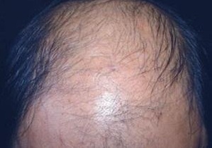 脱发之后长细毛怎么办,脱发后有绒毛怎么修复