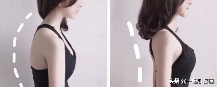 驼背怎么办最有效的方法,驼背怎么矫正最有效方法