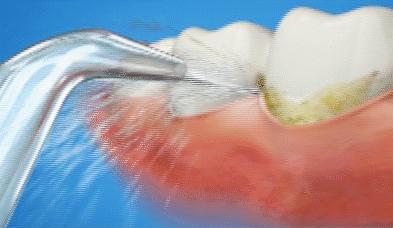 吃东西塞牙很严重怎么办,牙缝太大总塞牙导致牙疼