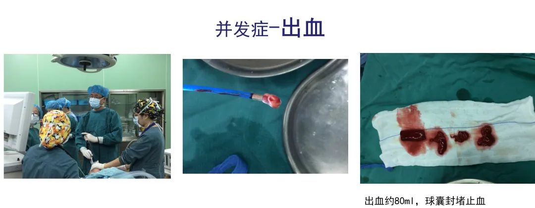 经皮肺穿刺活检术过程,经支气管冷冻肺活检