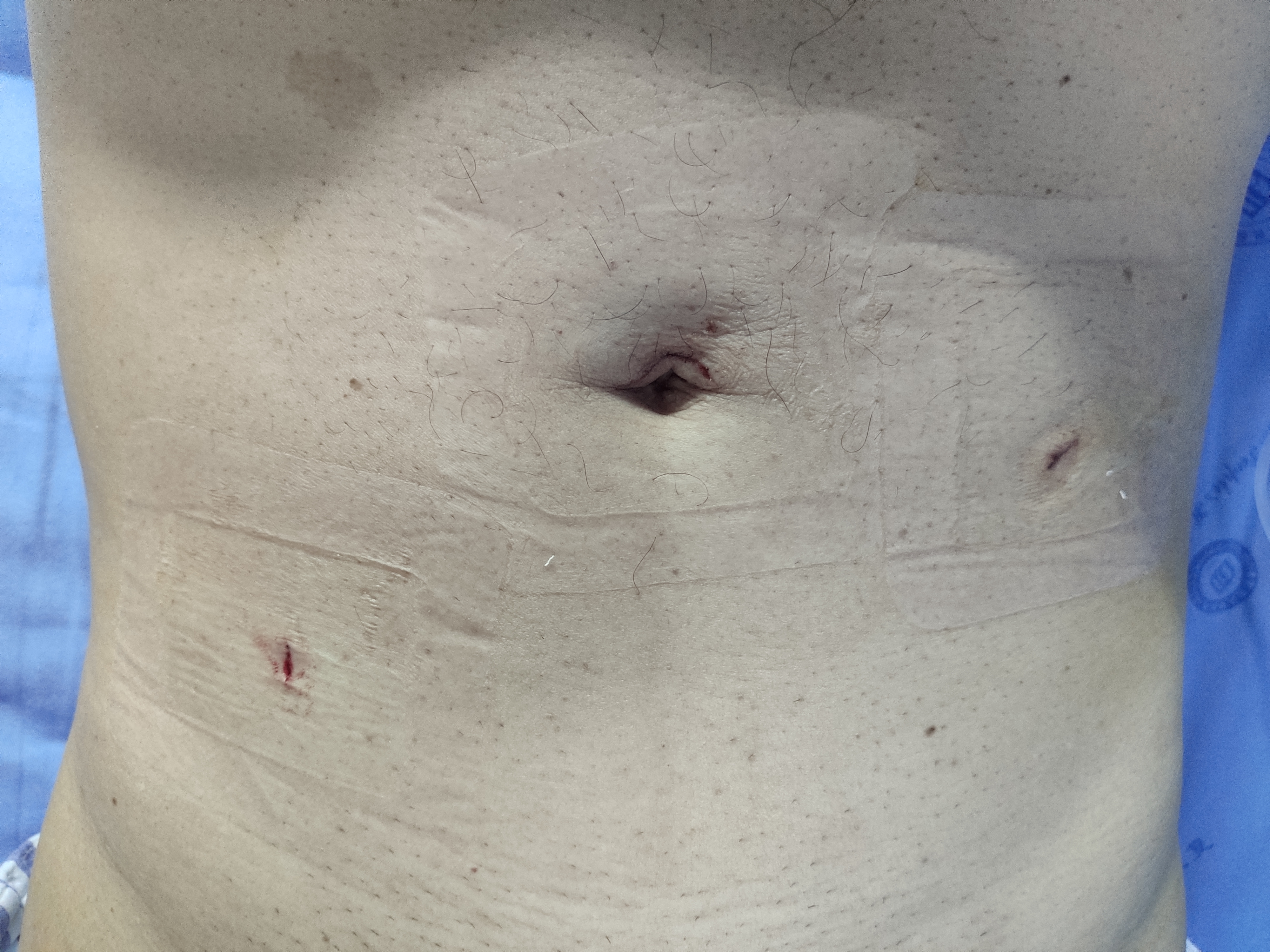 腹部包块肿瘤,腹部巨大囊性包块挂什么科室