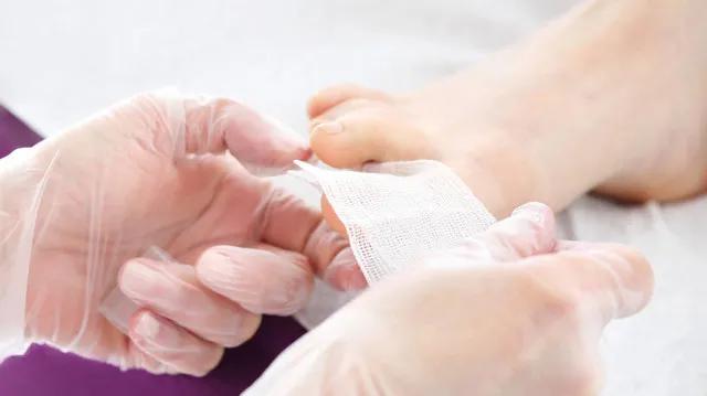 去修脚店治疗灰指甲需要多少钱,灰指甲医院治疗多少钱