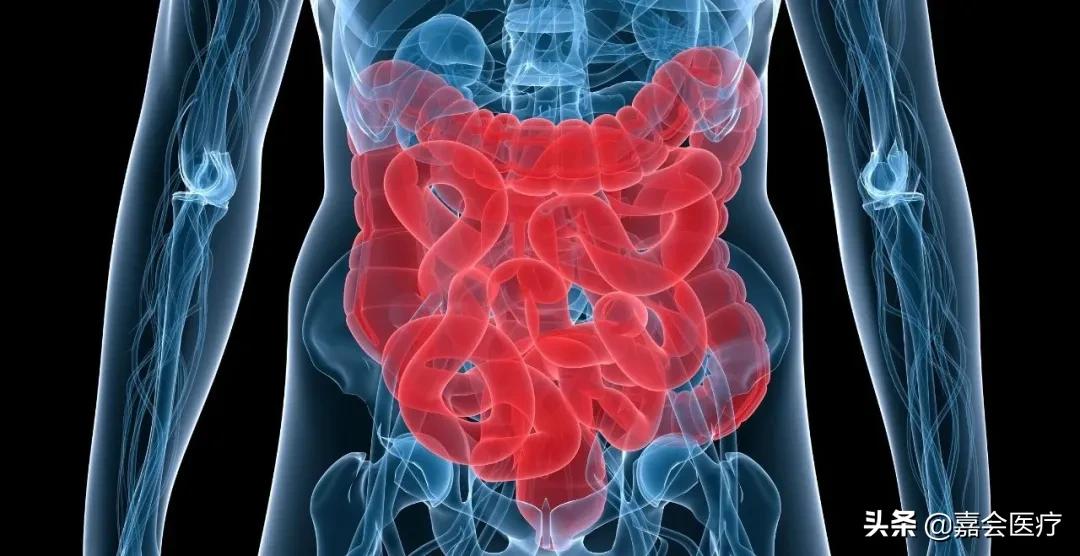 两个广基型息肉恶变几率高,认识炎症性肠病