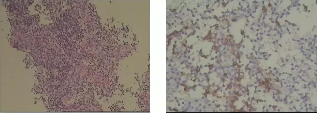 PCCM直播丨中年装修工人双肺多发空洞，奴卡菌＋曲霉菌如何治疗？