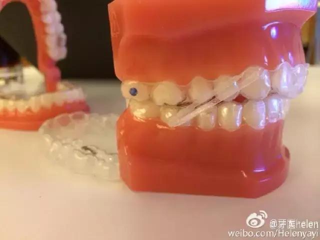 德国牙齿隐形矫正,牙科隐形矫正科普