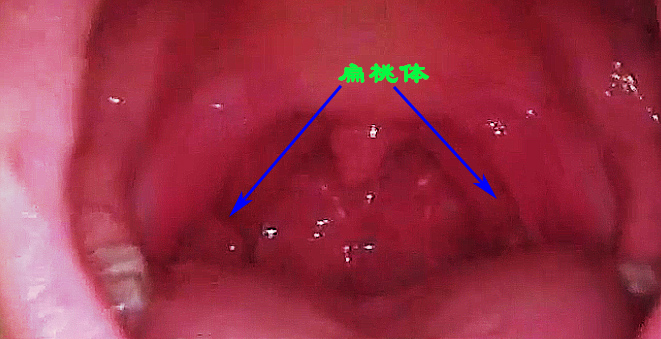 鱼刺卡喉咙没感觉了还用检查吗,小鱼刺卡喉咙吞咽没感觉
