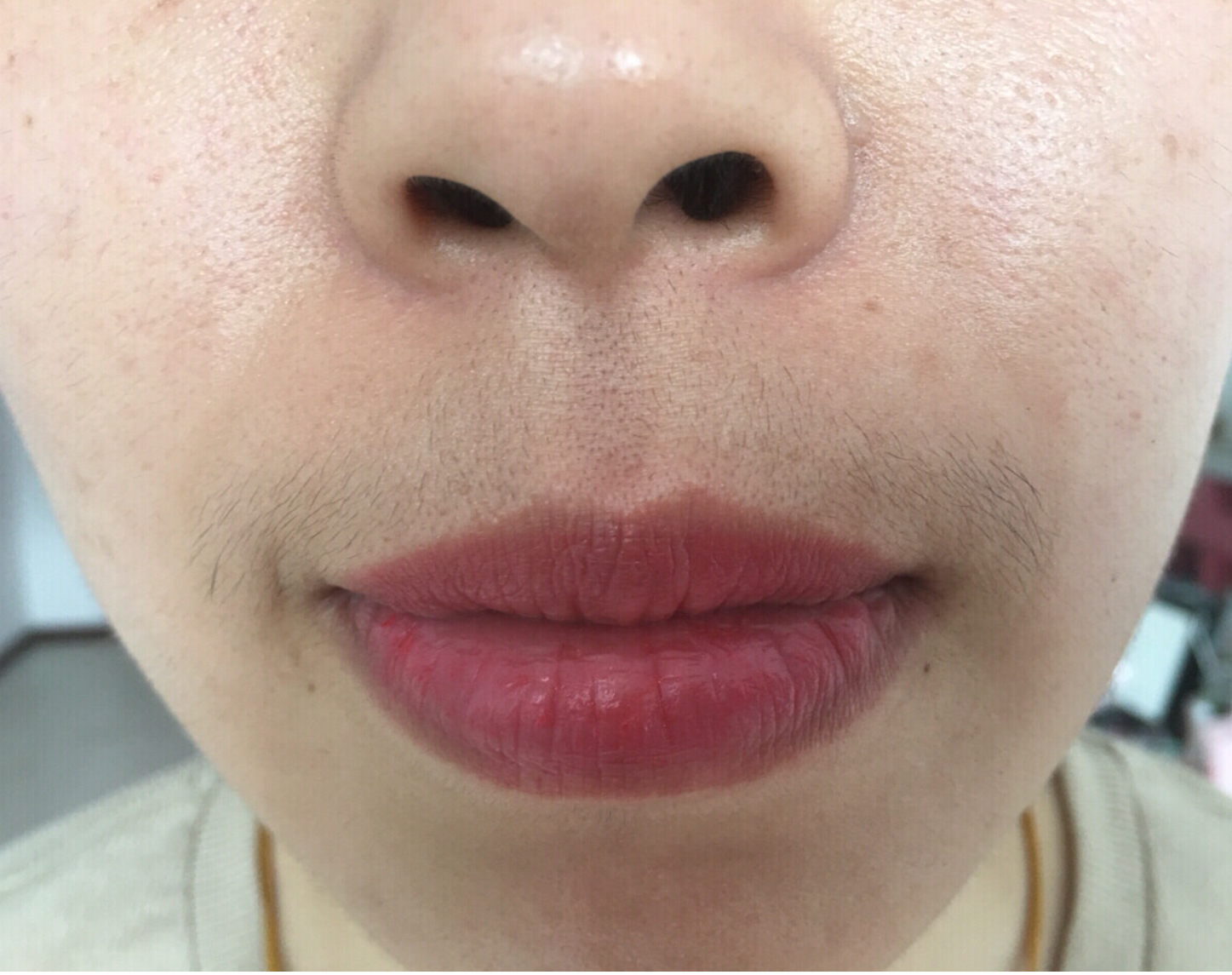 怎么去除唇周黑胡子,长小胡子怎么去除男