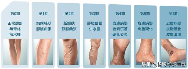 静脉曲张的症状自查,医学科普静脉曲张的原因