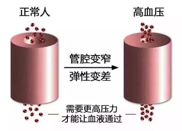 高血压难降压的原因,难降的高血压用什么药