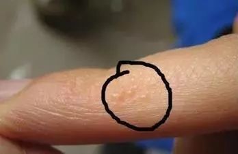 治疗脚气烂脚丫的小妙招,如何治疗脚臭脚气脚后跟开裂