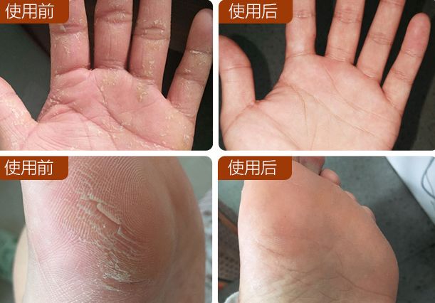 快速修复手干裂,冬季皮肤干燥脱皮面霜