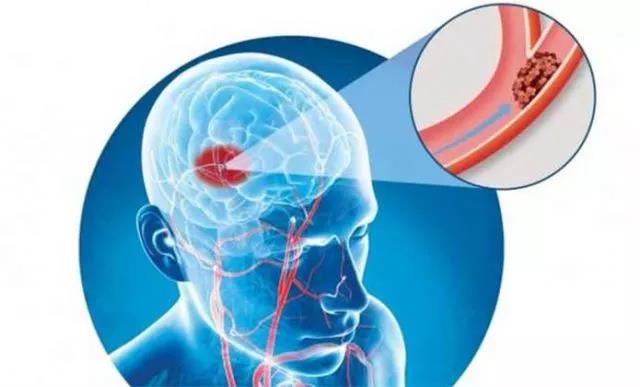 儿童会发生中风吗,小孩也会中风吗