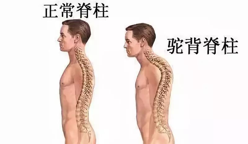 防驼背矫正神器步骤,纠正驼背神器视频