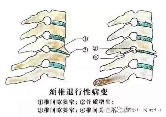 颈椎病压迫神经吃甲钴胺多长时间,颈椎病压迫神经微创手术要多少钱