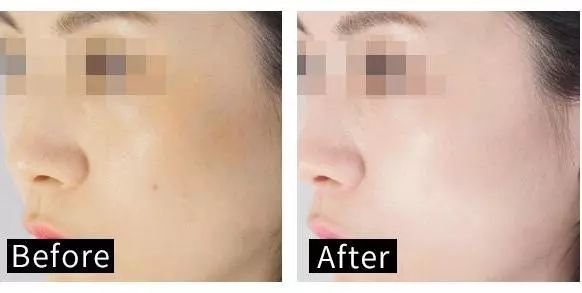 适合黄皮干皮用的面膜,黄皮黑皮适合用的面膜