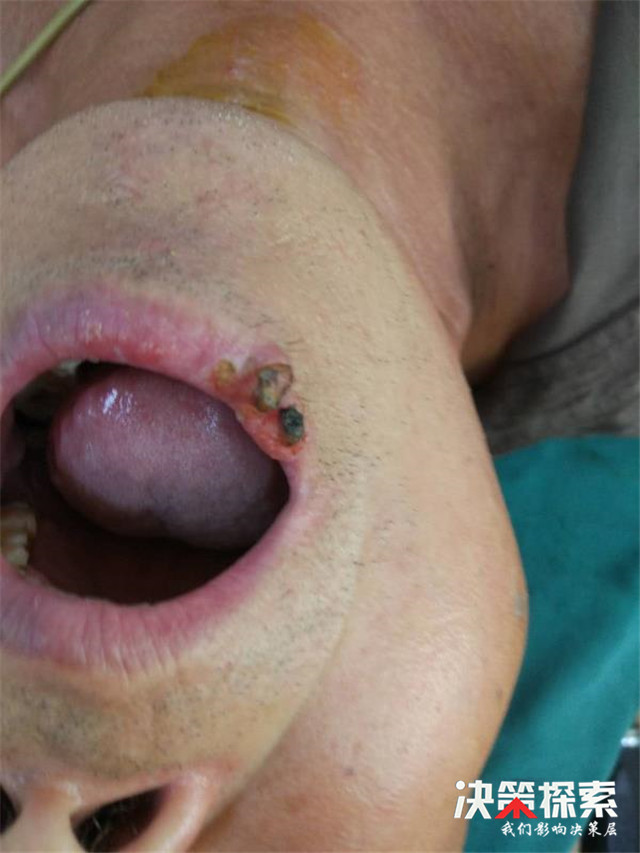 嘴唇肿块是癌症的早期信号,上嘴唇长了个肿瘤医生就说癌了