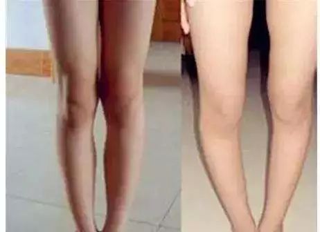 o型腿瑜伽视频,o型腿最快变直的瑜伽