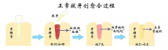 拔牙后什么时候能吃荤菜,拔牙后吃东西不用忌口吧