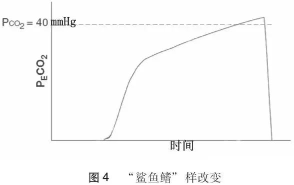 呼气末二氧化碳检测的临床意义,呼气末二氧化碳检测操作流程