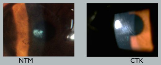 孙旭光眼科医生,孙旭光大夫角膜塑形镜危害