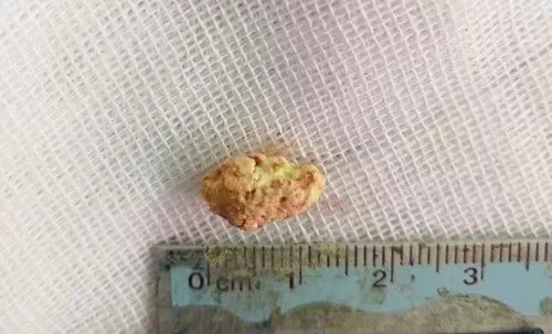 杭州男子右脸肿胀疼得吃不下饭，竟是嘴里长了颗“石头”