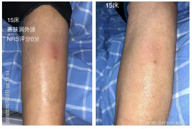 三发性静脉炎的预防措施有哪些,临床上如何预防化疗引起的静脉炎