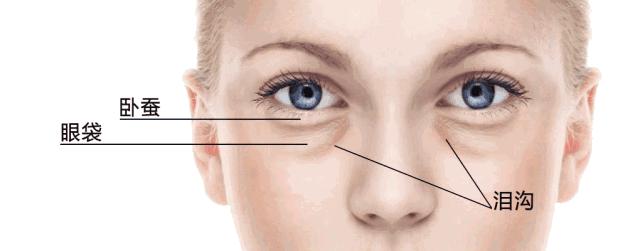 去掉眼袋之后天壤之别,无美颜无滤镜遮泪沟眼袋