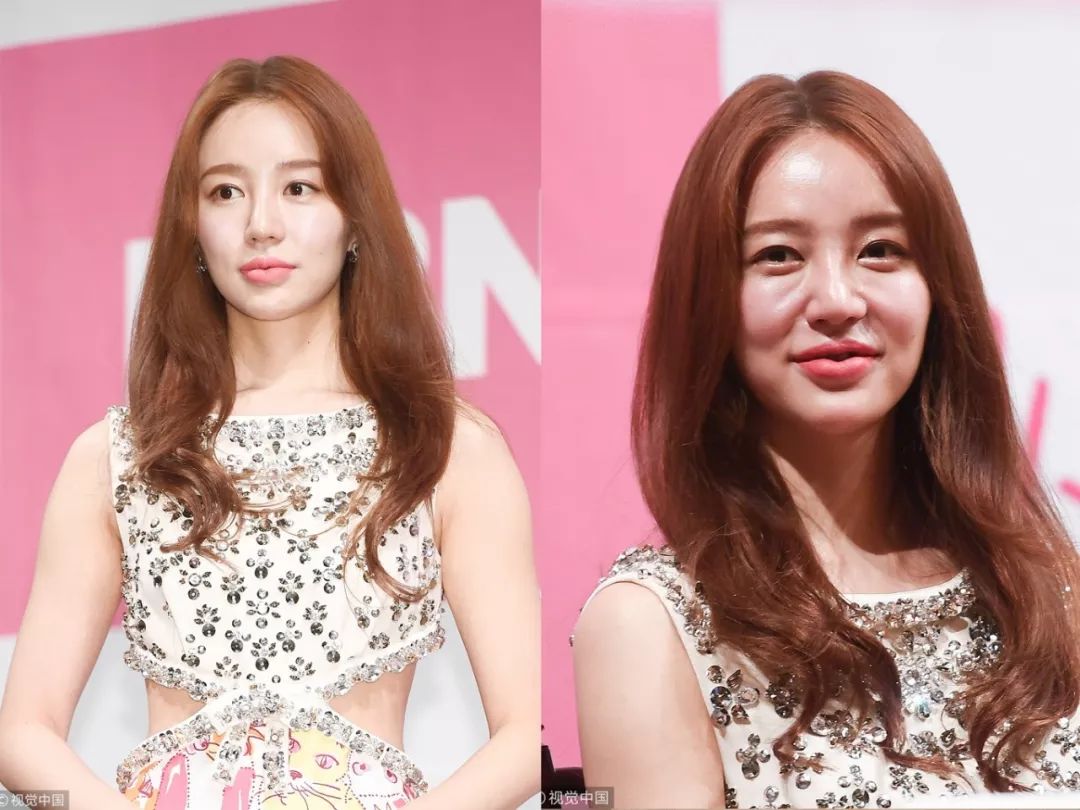 去掉眼袋之后天壤之别,无美颜无滤镜遮泪沟眼袋