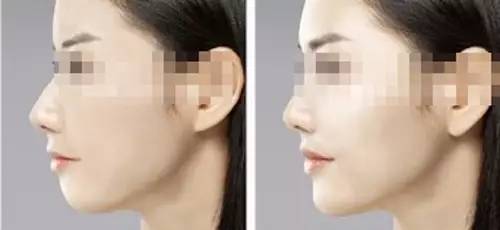 玻尿酸填充是个无底洞吗,玻尿酸是不是无底洞