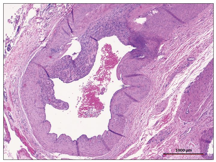 柳叶刀死而复生的病人,柳叶刀人造子宫