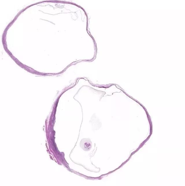 头皮发麻女生,头上长个包取出一条虫