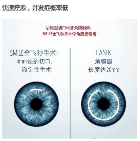 smile全飞秒手术优缺点,smile全飞秒和smart详细对比