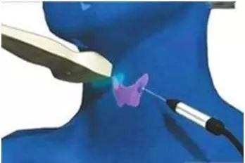 微波消融术能治多大肿瘤,微波射频消融术治疗肿瘤