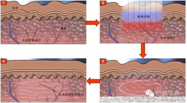 激光美容祛疤的真实性,激光美容真的靠谱吗