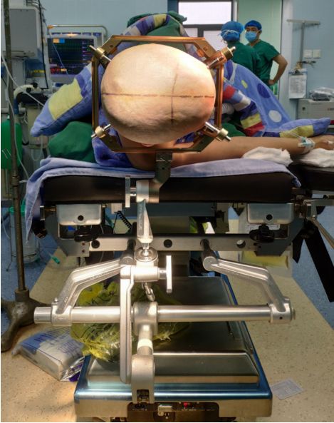 赞！重庆三博江陵医院成功开展脑干占位立体定向活检术！