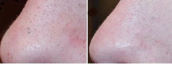 蜂蜜加白醋有什么效果,蜂蜜加白醋怎么样