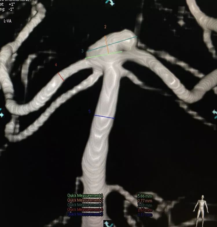 柳暗花明专栏|栓塞颅内动脉瘤时微导管无法穿过LVIS支架网眼怎么办