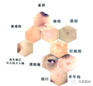 「崇州妇幼」神奇督脉灸——冬日里的健康火!