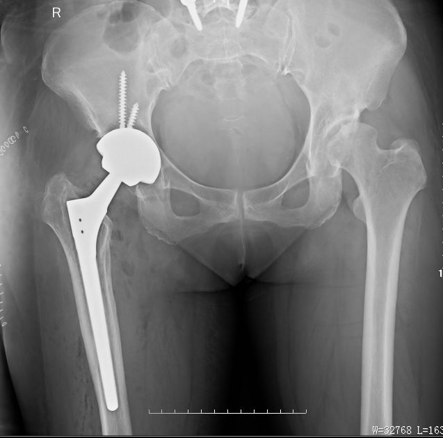 「筋骨堂」人工髋关节并非一劳永逸