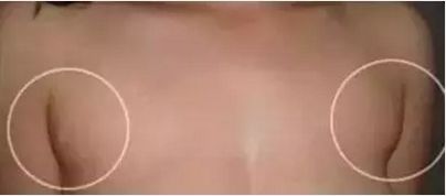 你的耳后有鼓包吗赶紧对照看看,耳后有个鼓包怎么回事