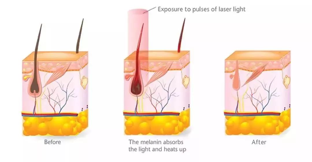 春天要来了,宝贝你怎么长胡子了?(脱毛秘籍)