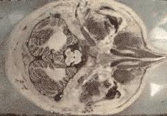 核磁共振对人体的副作用有哪些,核磁共振增强伤身体吗