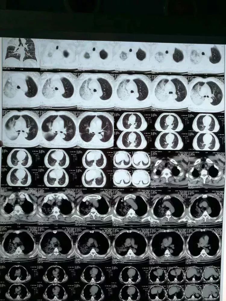 渭北中心医院呼吸内科成功救治一例重症肺炎患者