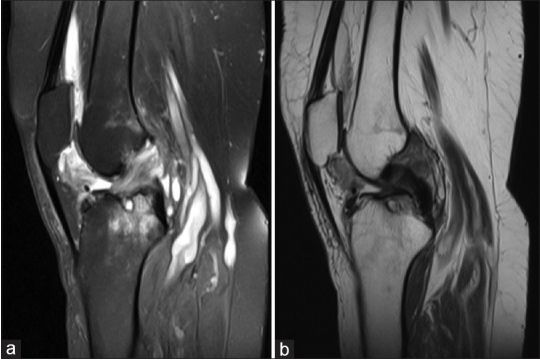 色素沉着绒毛结节性滑膜炎常见吗,绒毛样结节性滑膜炎