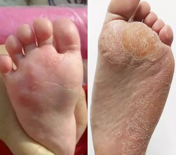 脚臭怎么办教你一招永远除臭,脚臭有什么办法除臭小妙招