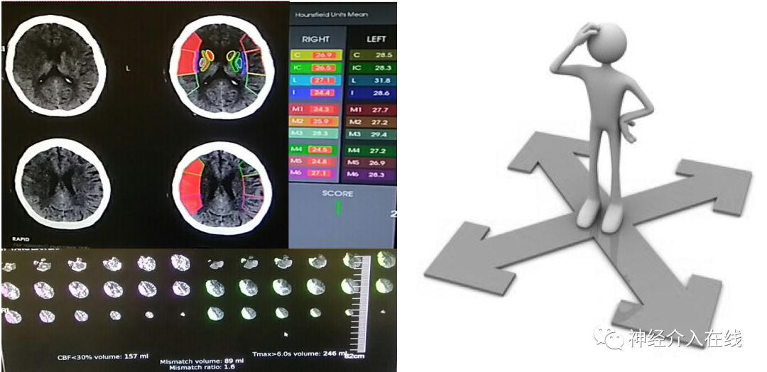 文献新萃·第六期|血管内治疗对大梗死核心患者是杯水车薪还是救命稻草？
